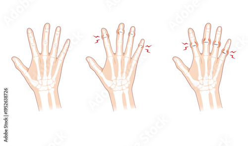 正常な手指とへバーデン結節、ブシャール結節の骨