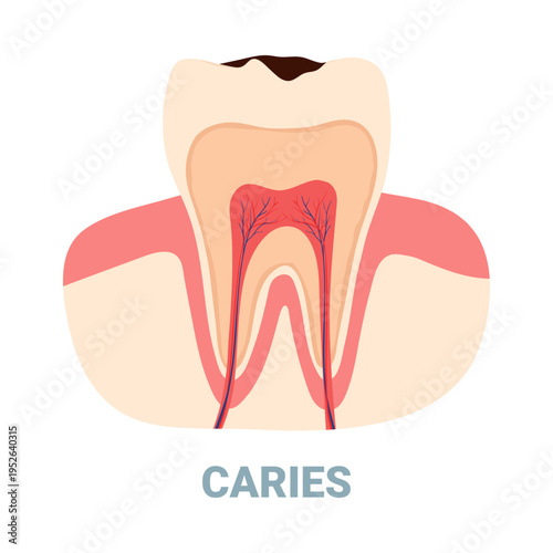 Isolated cross section of tooth showing caries and dental pulp for medical education vector illustration