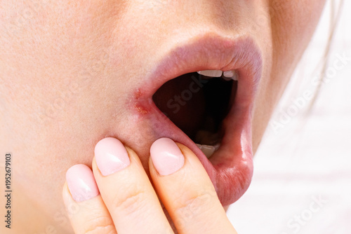 Side view of woman face with problem of dry skin on corner of chapped lips and visible irritation. Angular cheilitis, cracks, visible irritation in the corners of mouth, redness and inflammation.