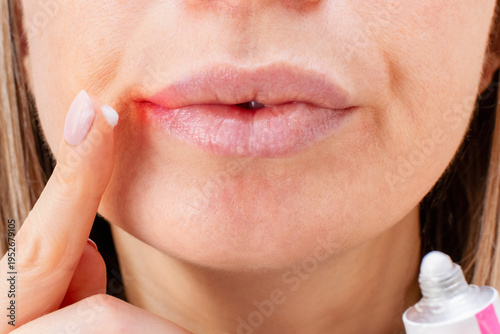 Tableau sur toile Woman applying healing cream with finger to dryness irritation and redness lips corner in cold winter season, close-up