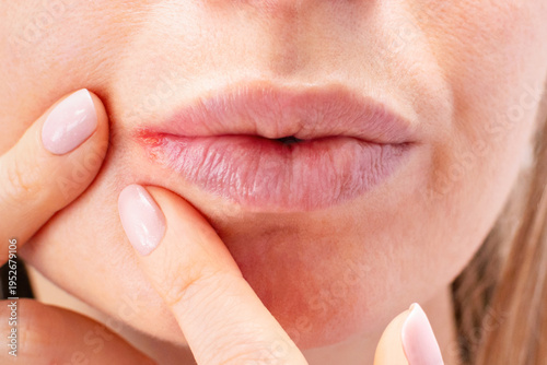 Close up of woman face with problem of dry skin on corner of chapped lips and visible irritation. Angular cheilitis, cracks, visible irritation in corners of the mouth, redness and inflammation.