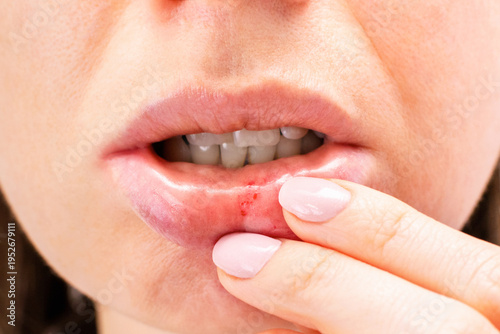 Close-up of females lower lip with a visible injury with red drops or ulcer on the inner side. Trauma or irritation, bacterial inflamination, stomatitis, erosion of lips skin.