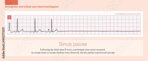 In the event of a sinus arrest, if an escape beat and escape rhythm fail to occur in a timely manner, the patient will experience symptoms of syncope.
