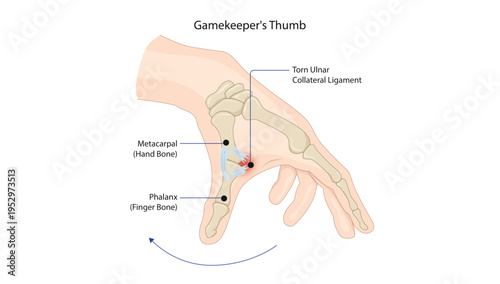 Gamekeeper's Thumb
Injury of the ulnar collateral ligament of the thumb at the metacarpophalangeal joint, usually caused by forced thumb abduction.