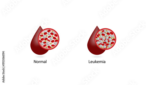 Leukemia, blood cancer. Difference between healthy normal blood and blood cancer. Blood vessel with leukocytes, erythrocytes, platelets and lymphocytes. Vector illustration.