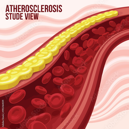 Atherosclerosis: Artery Cross-section with Plaque Buildup and Blood Cells