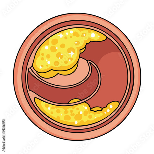 Atherosclerosis Plaque Buildup in Artery Cross-section. Medical Illustration.