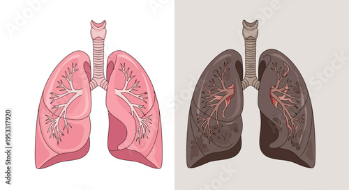 Healthy and smoker lungs comparison.