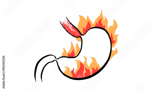 Gastroesophageal reflux pain