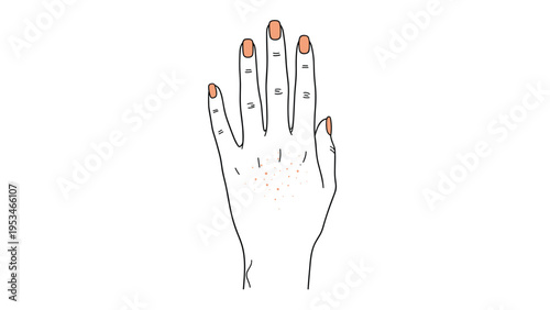 Close up drawing of a human hand showing small red spots or a rash on the skin to illustrate a dermatological condition or allergy.