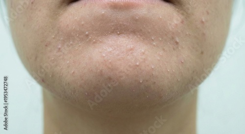 Closed Comedones Whiteheads on Chin Skin Texture.