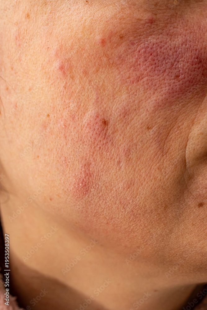 Naklejka premium Red rash eczema on a woman face due to liver disease , close up texture