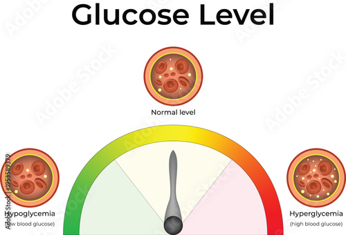 Blood Glucose Level Illustration with Hypoglycemia, Normal, and Hyperglycemia