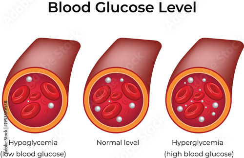 Blood Glucose Level Illustration with Hypoglycemia, Normal, and Hyperglycemia