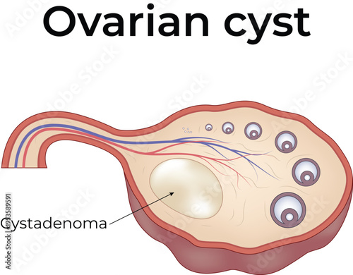 Ovarian Cyst and Endometriotic Cyst Medical Illustration