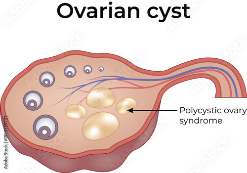 Ovarian Cyst and Endometriotic Cyst Medical Illustration