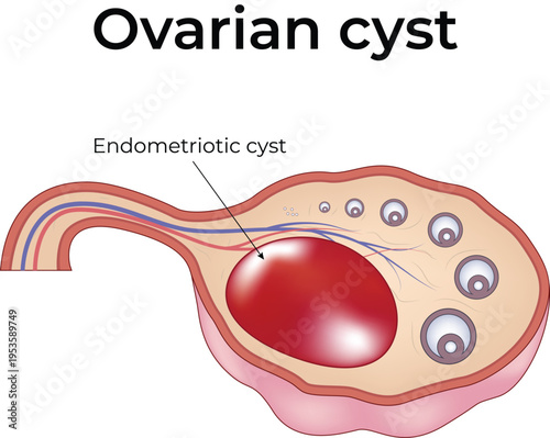 Ovarian Cyst and Endometriotic Cyst Medical Illustration