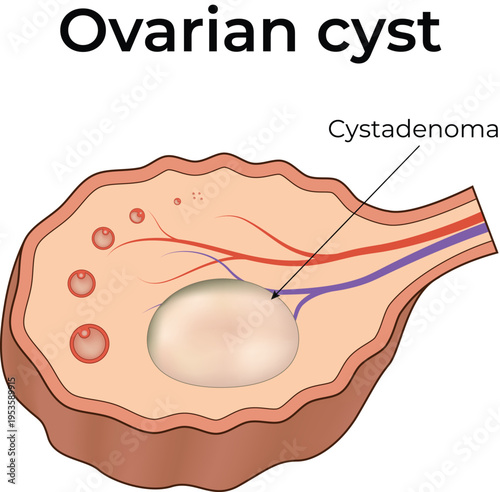 Ovarian Cyst and Endometriotic Cyst Medical Illustration
