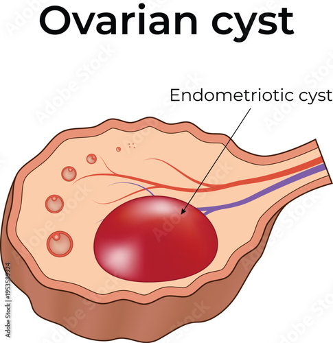 Ovarian Cyst and Endometriotic Cyst Medical Illustration