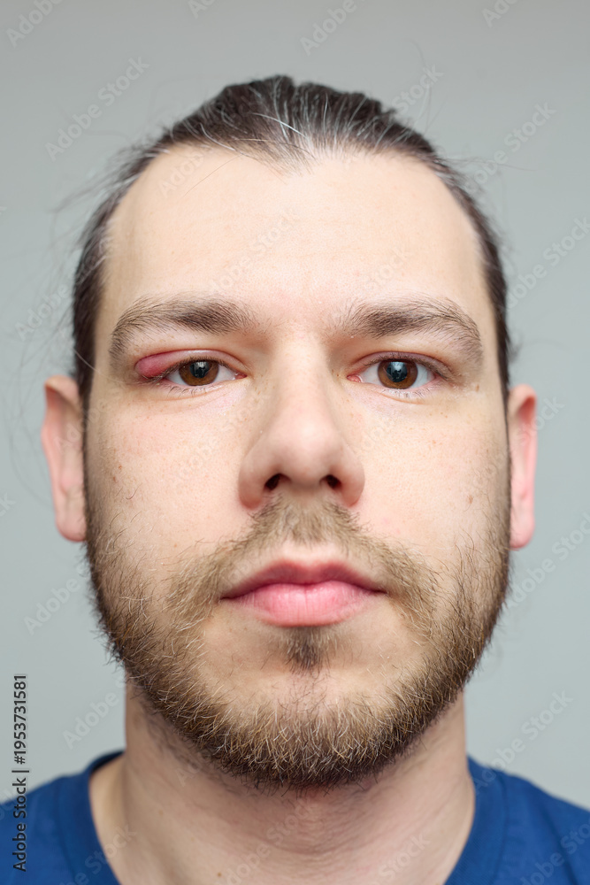 Obraz premium Swollen red eyelid close-up, eye inflammation or stye, medical condition