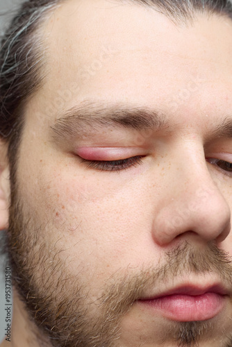 Swollen red eyelid close-up, eye inflammation or stye, medical condition