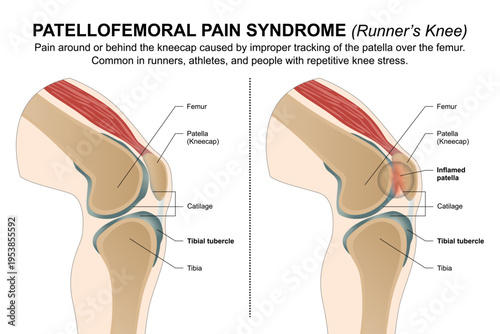 Patellofemoral Pain Syndrome (Runner’s Knee)