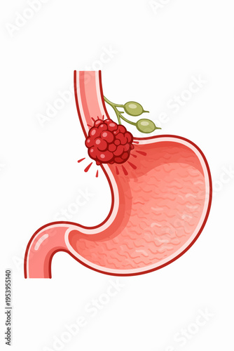 Illustration of a cancerous tumor growing on the stomach wall with lymph nodes nearby