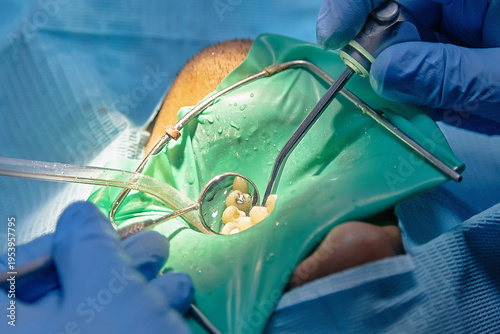 Schilderij op canvas Close-up of dentist performing cavity treatment and tooth filling with rubber dam isolation
