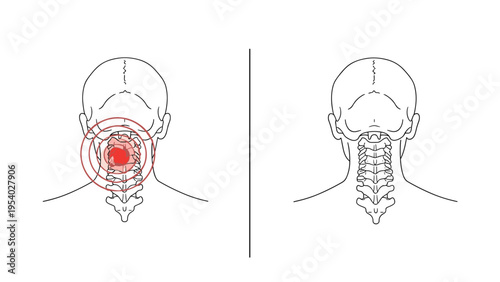 Human neck and spine anatomical illustration with red circles highlighting the focal area of pain and inflammation.