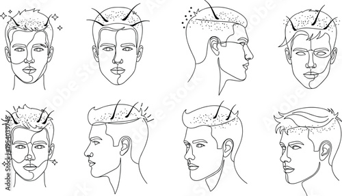 Hair transplant procedure stages vector illustration with scalp treatment and growth process line art set for dermatology and medical education