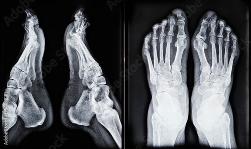 X-rays of an elderly woman's feet.