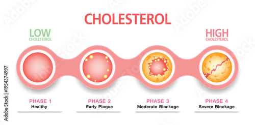 Cholesterol in artery, health risk , vector design