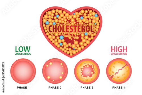 Cholesterol in artery, health risk , vector design