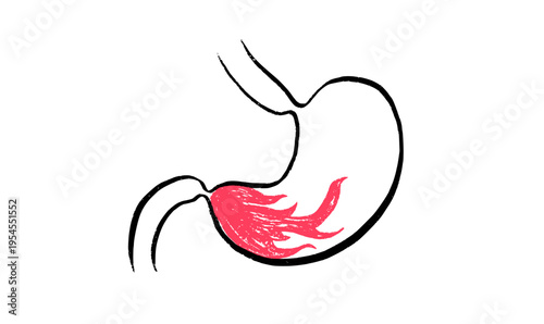 Gastroesophageal reflux pain