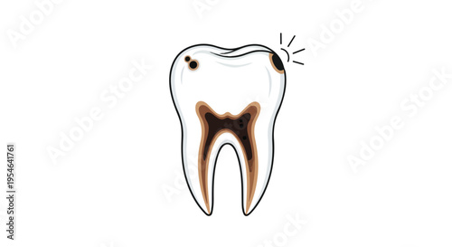 Illustration of a tooth with a cavity and decay, depicted in a simple line drawing style on a white background.