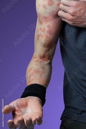 Itchy rash and peeling skin of the arm