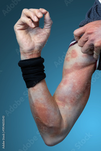 Itchy rash and peeling skin of the arm