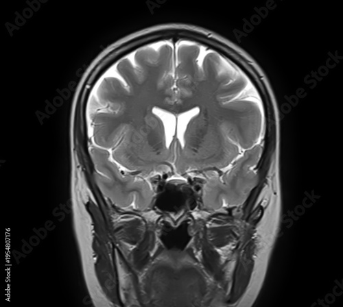 Normal brain MRI, coronal T2-weighted image showing cerebral hemispheres, cortex, lateral ventricles, basal ganglia, thalami, temporal lobes and sphenoid sinus.