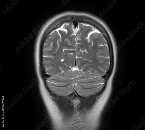 Normal brain MRI, coronal T2-weighted image showing cerebral hemispheres, cerebral cortex, cerebellum, cerebellar hemispheres, vermis and posterior fossa.