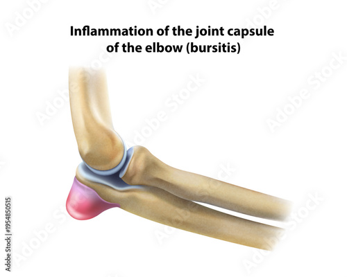 Elbow bursitis. Isolated vector illustration