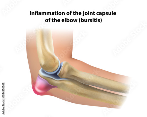 Elbow inflammation. Isolated vector illustration