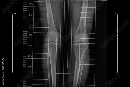 Foto full length standing scanogram of the bilateral lower limbs, captured from the p