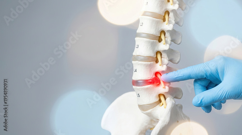 Lumbar spine model spinal disc herniated disc back pain red inflammation gloved hand medical demonstration orthopedic concept human skeleton healthcare anatomy model with herniated lumbar spinal