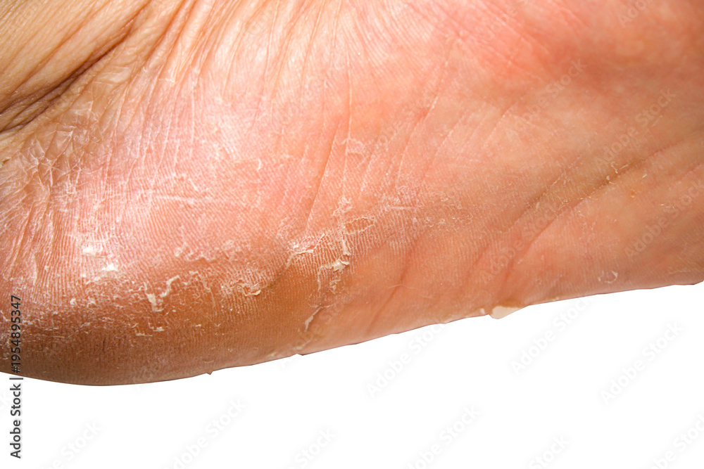 Fototapeta premium Close-Up View of Dry Skin on Human Foot Sole with Visible Cracks