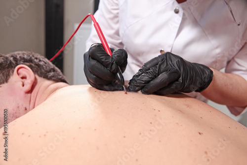 Фотография Removal of papillomas and moles