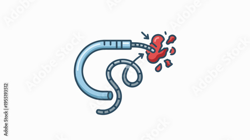 Medical illustration of a catheter-based procedure, showing a blue catheter and a flexible wire fragmenting a red mass, suggesting stone or clot removal.