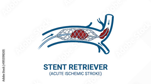 Illustration shows a stent retriever device deployed in a blood vessel to remove a blood clot causing an acute ischemic stroke.