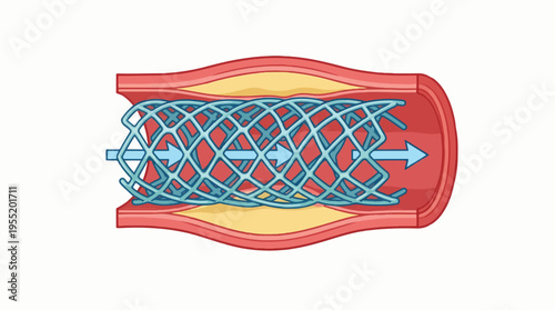 Illustration showing a stent being deployed inside a blood vessel, opening up a narrowed artery to improve blood flow.