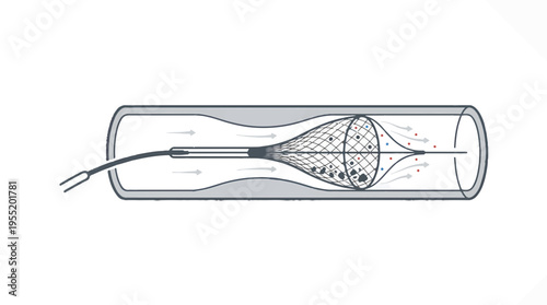 Medical illustration showing a snare device capturing debris within a blood vessel.