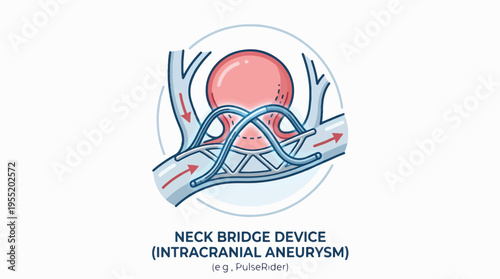 Illustration of a neck bridge device used to treat an intracranial aneurysm, showing its placement within blood vessels.